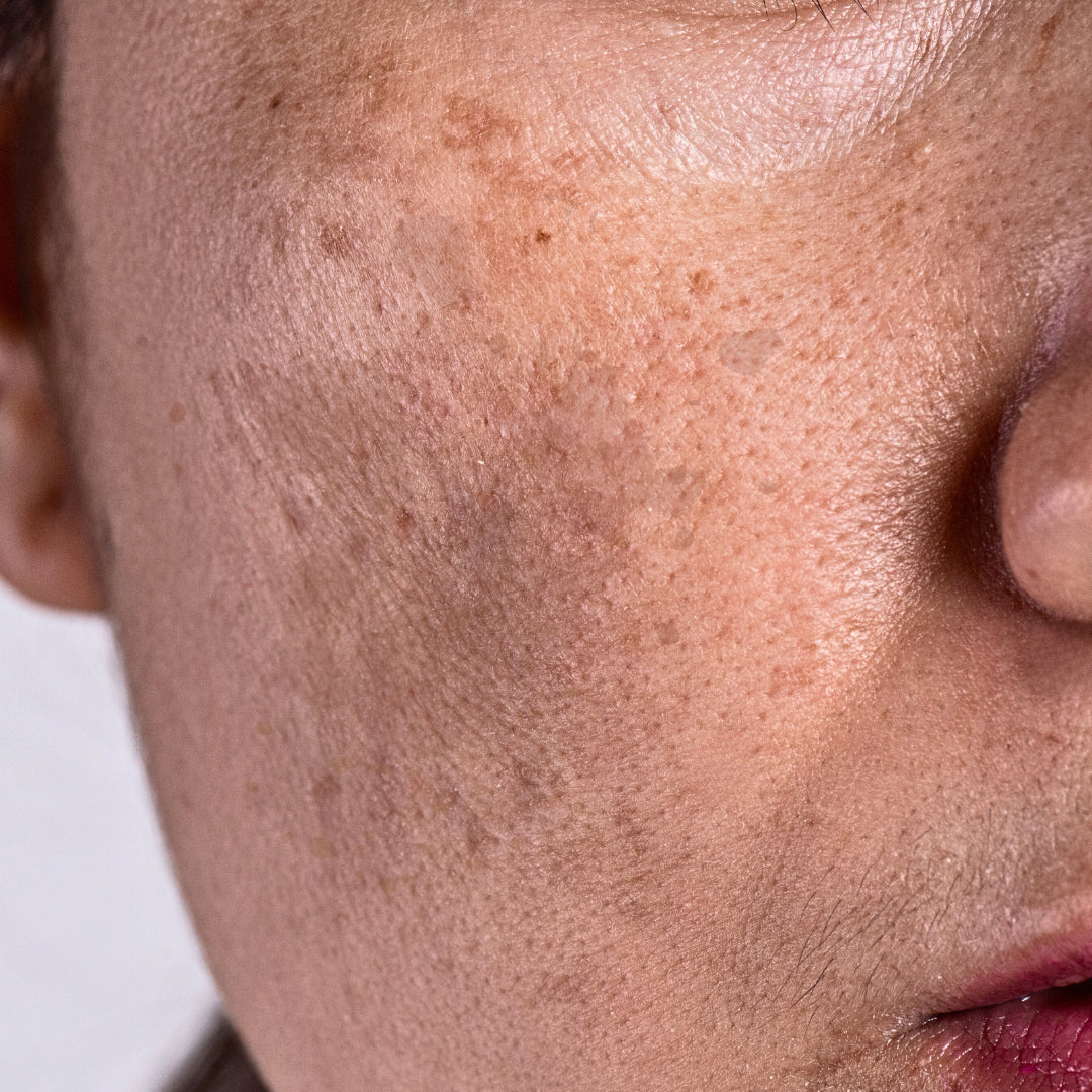 Pigmentation