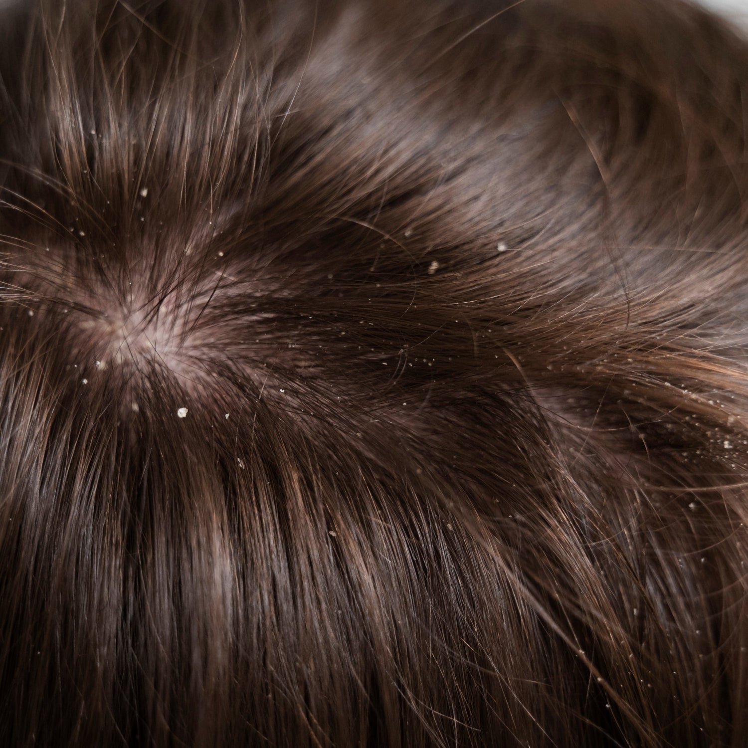 Dandruff / flacky scalp