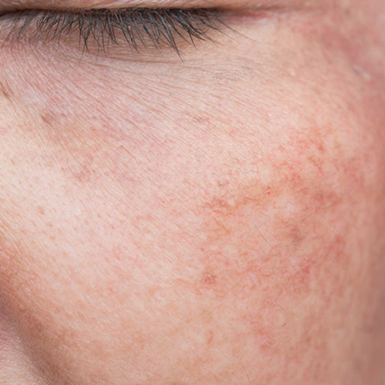 Sun Damage